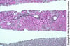 Nefritis lúpica: focal (clase III)