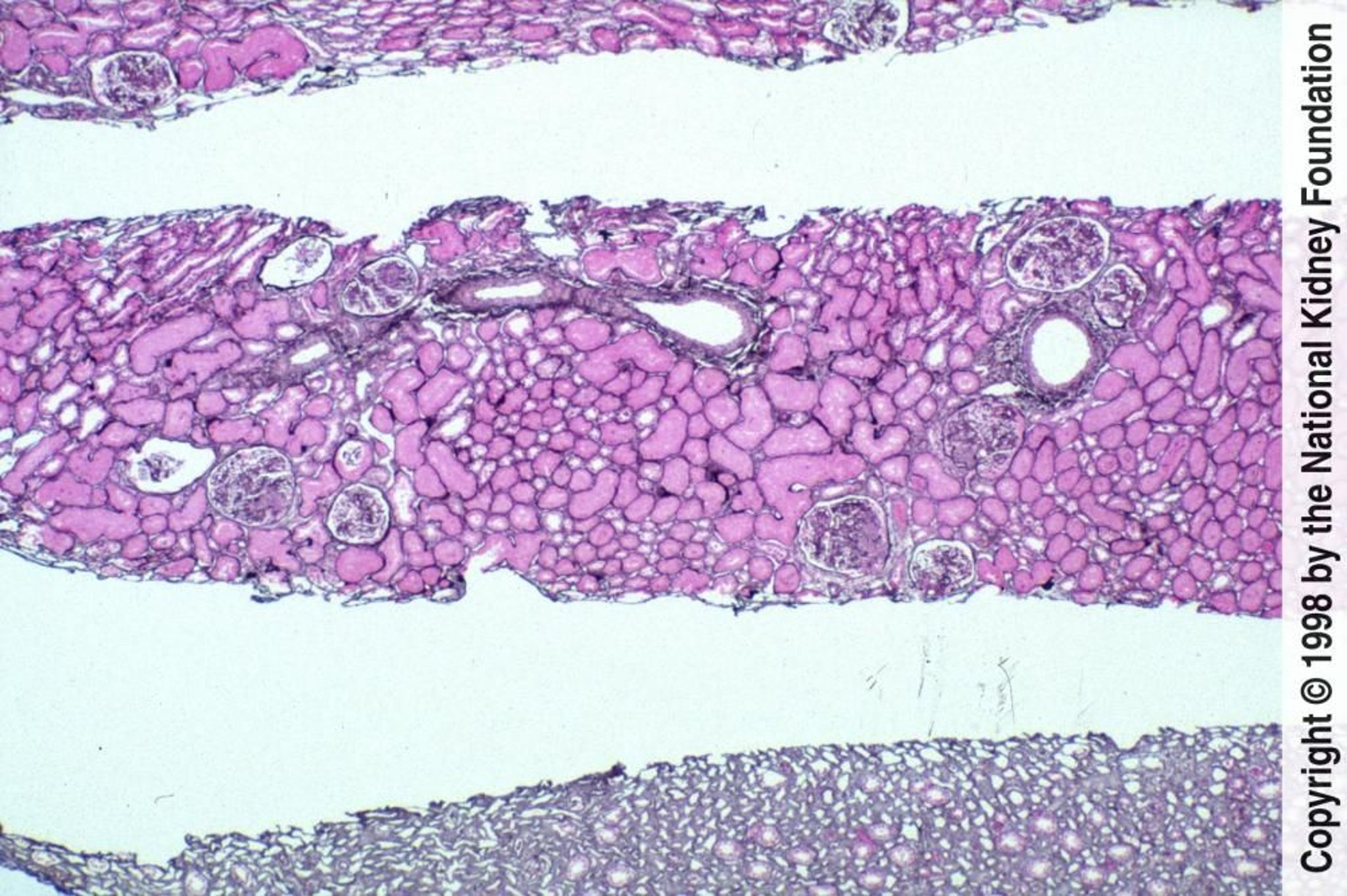Nefritis lúpica: focal (clase III)