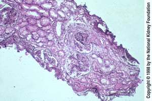 Nefrite lupica, diffusa (classe IV)