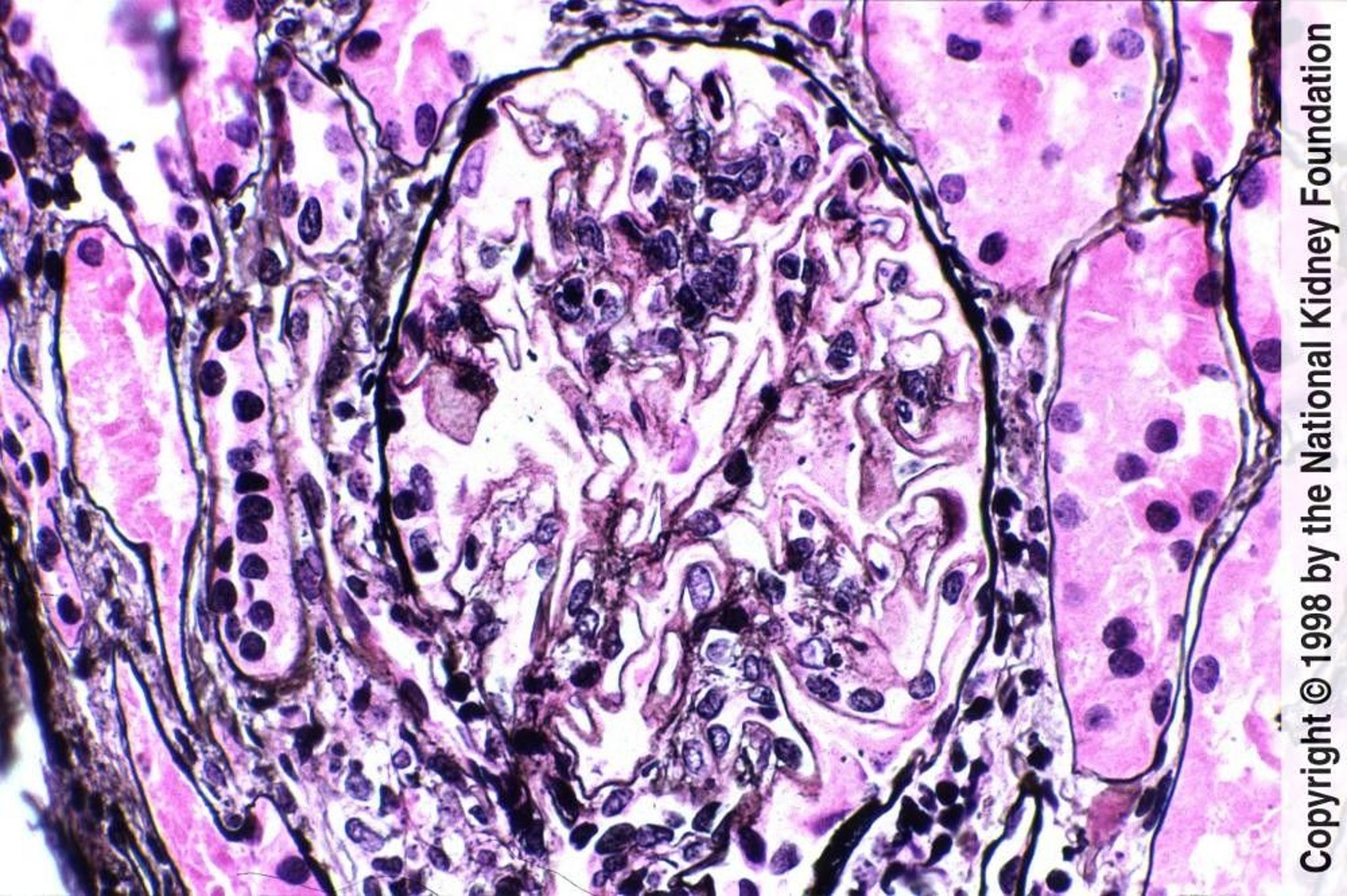 Lupus Nephritis—Membranous (Class V)