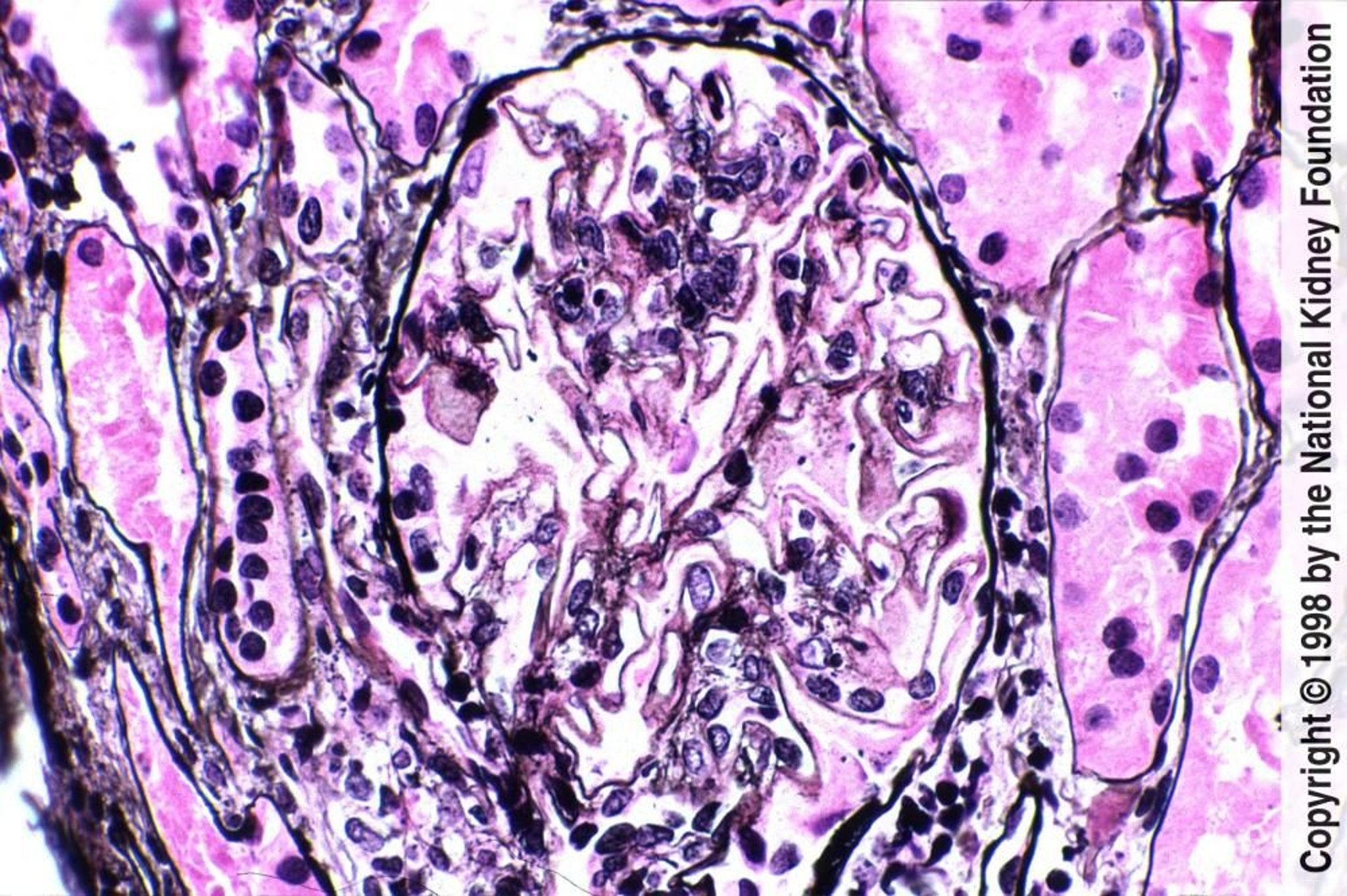 Lupus-Nephritis - membranöse (Klasse V)