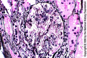 Nefrite lupica-membranosa (classe V)