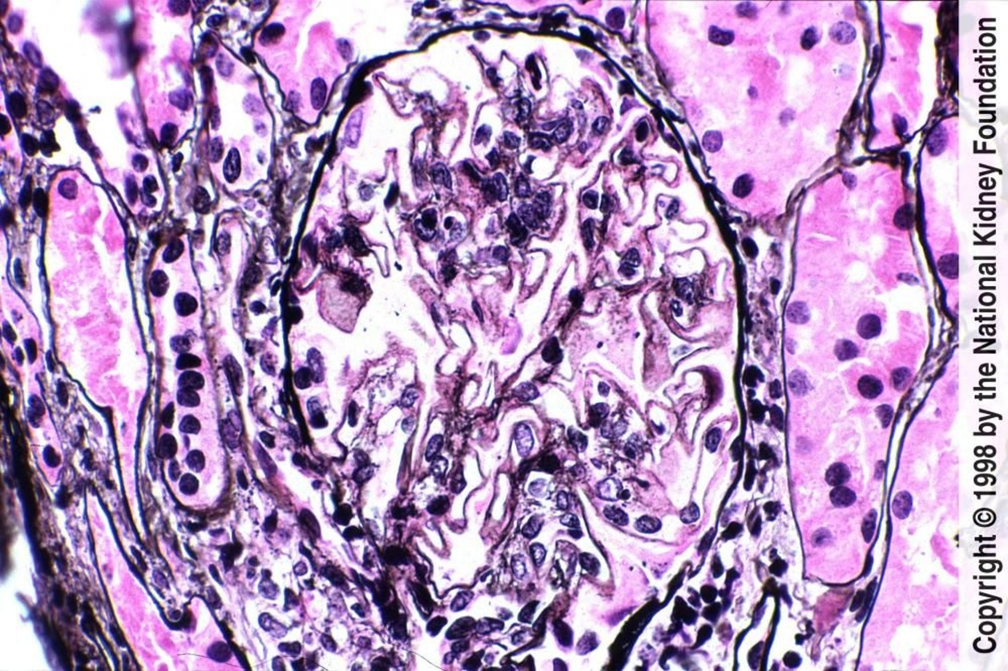 Viêm thận do lupus – Màng (Loại V)