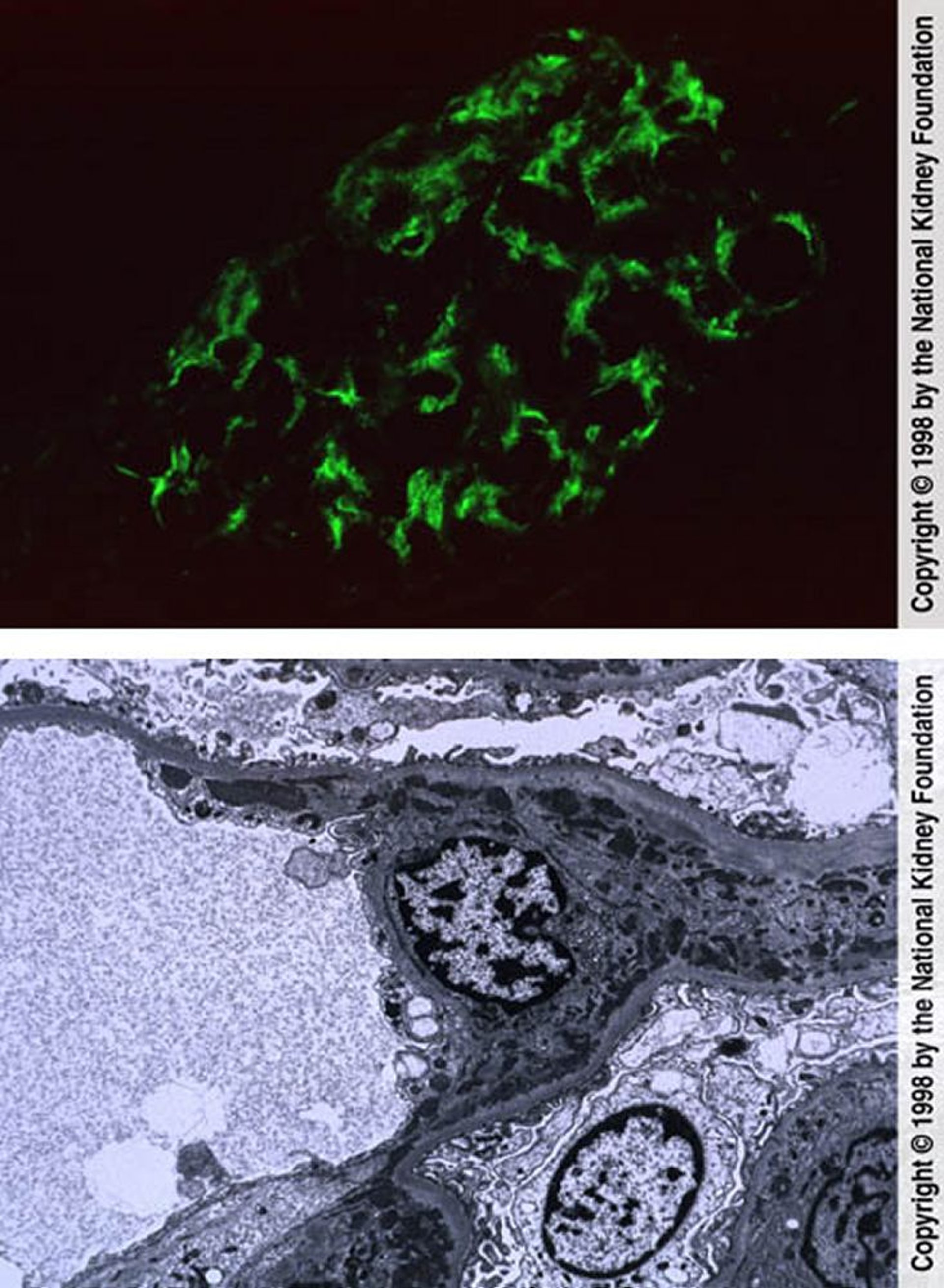 Nefritis lúpica: proliferativa mesangial (clase II)