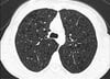 Lymphangioleiomyomatosis