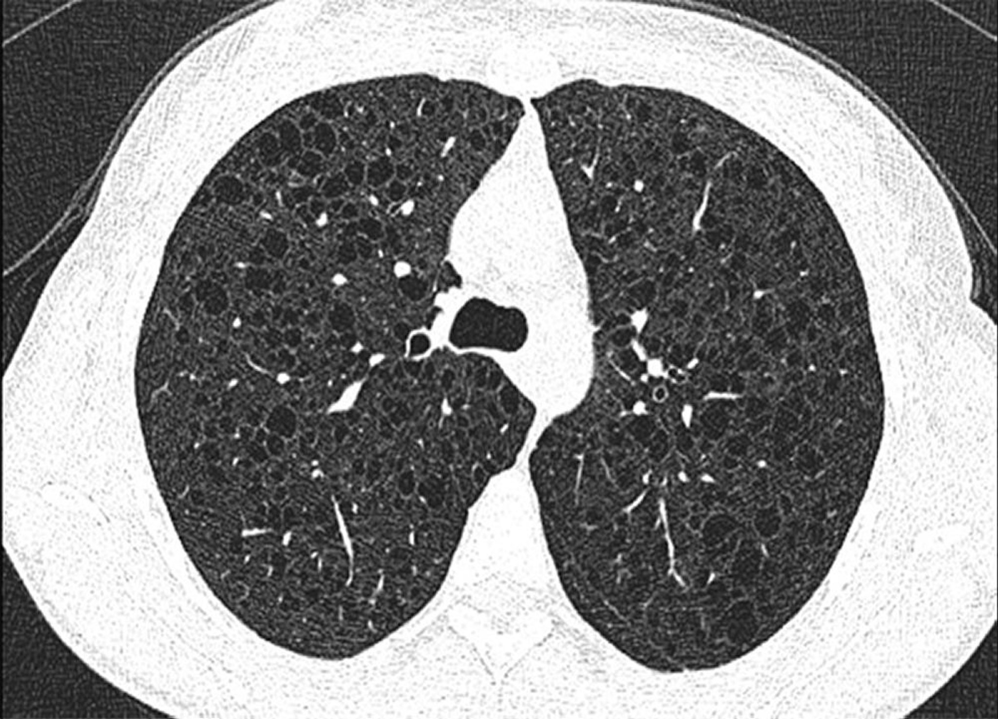 Bệnh phổi đột lỗ