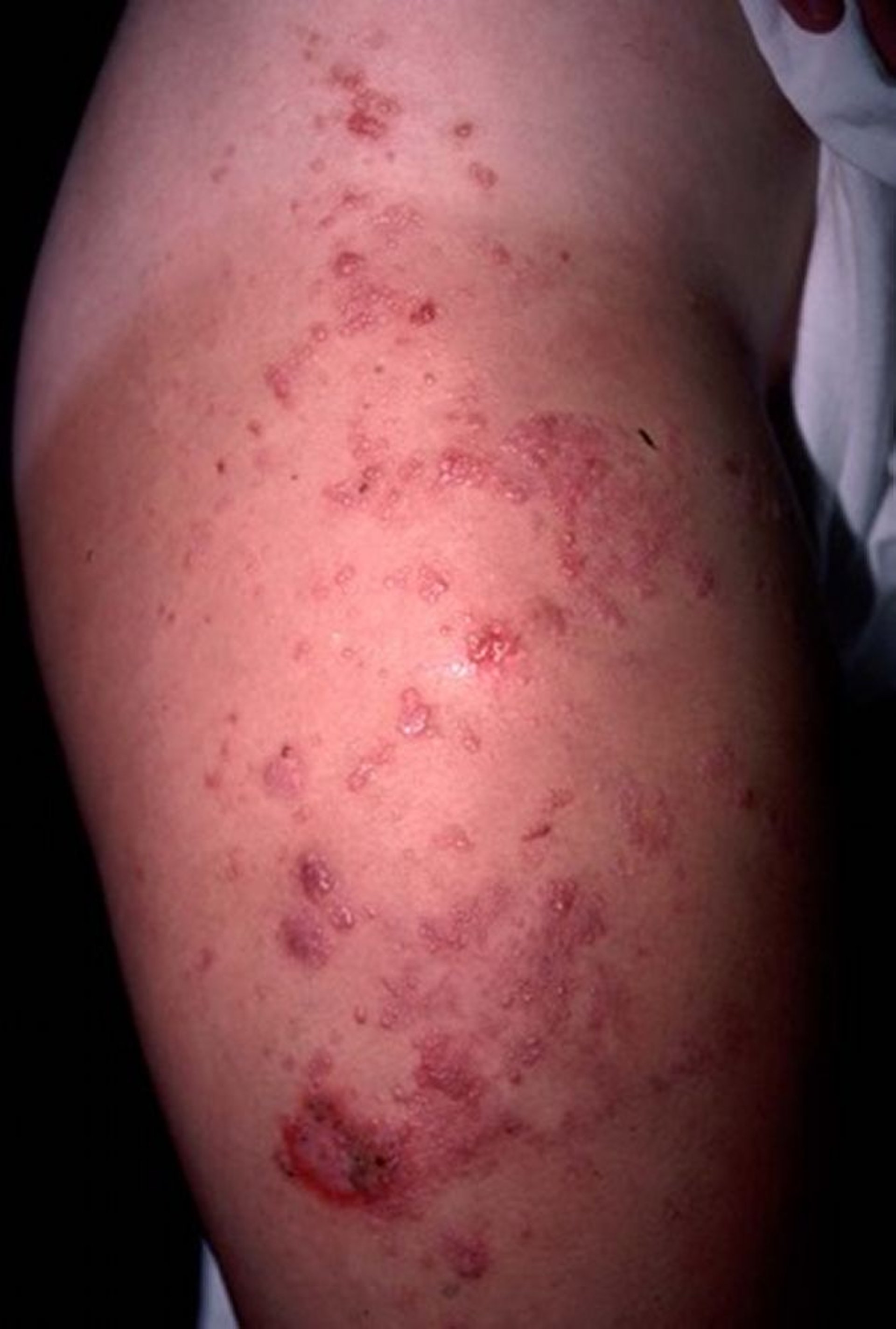 Linfangioma circoscritto