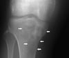 Lymphoma of Bone
