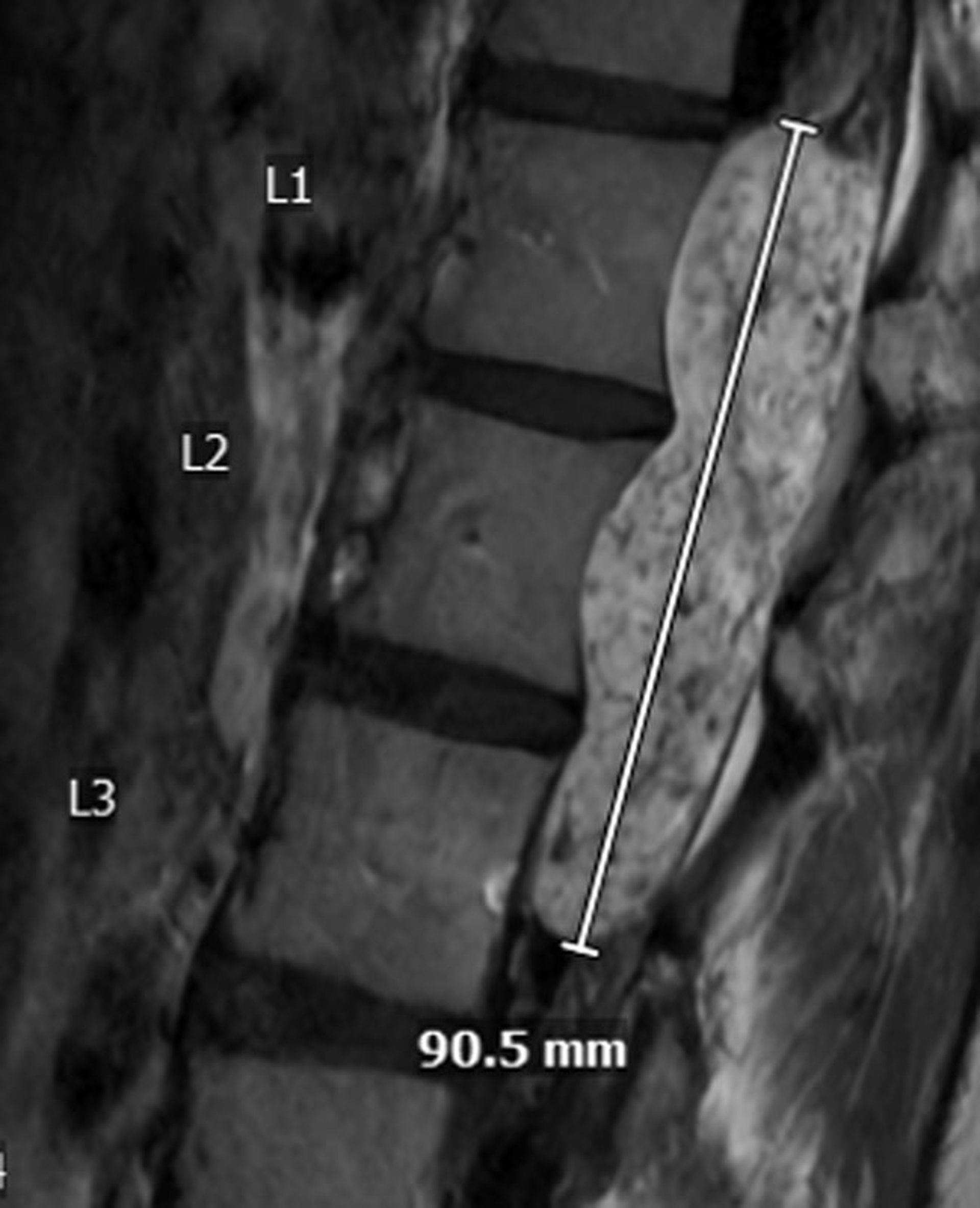 Myxopapillary Ependymoma
