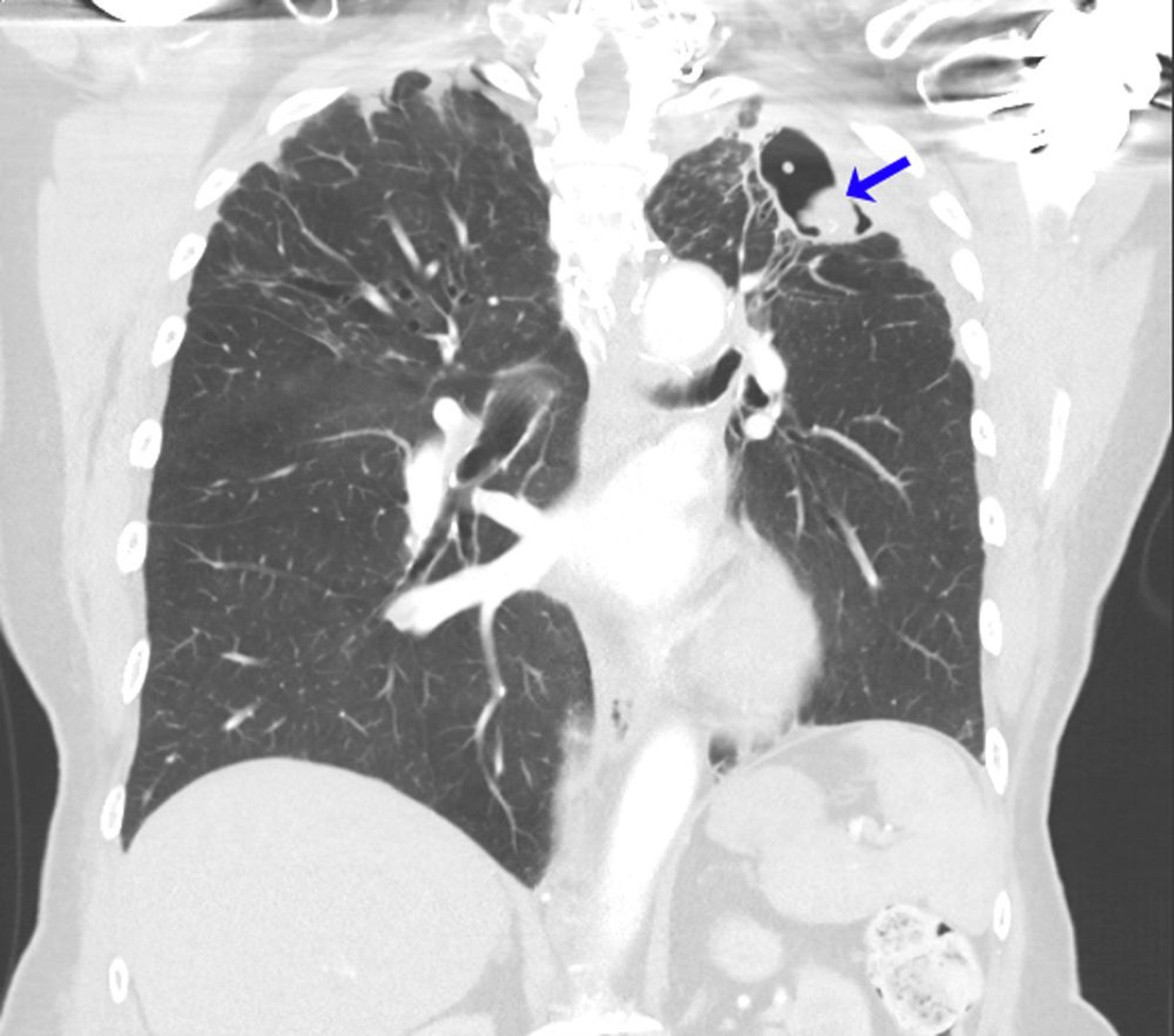 Recurrent Aspergilloma
