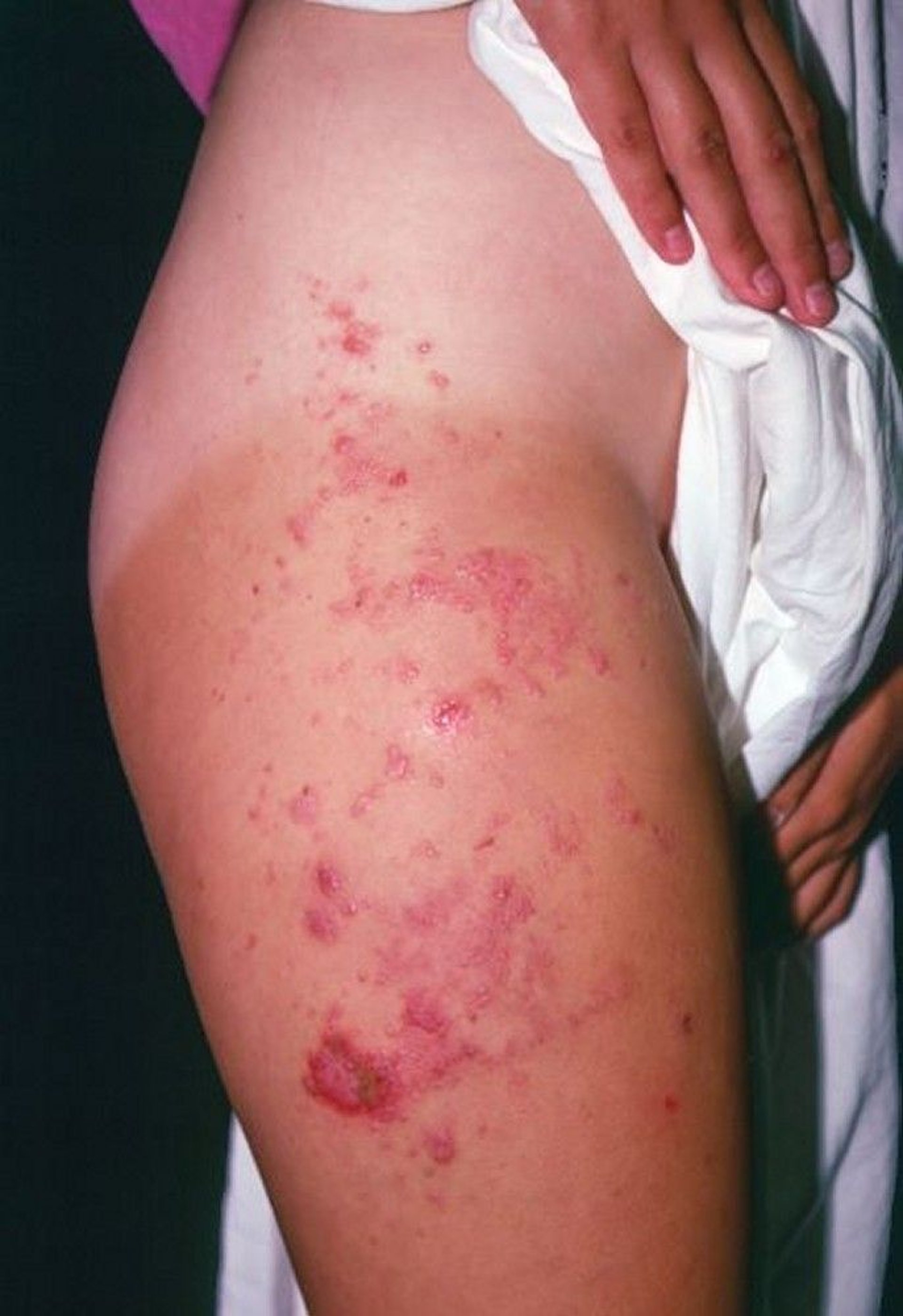 Lymphangioma circumscriptum