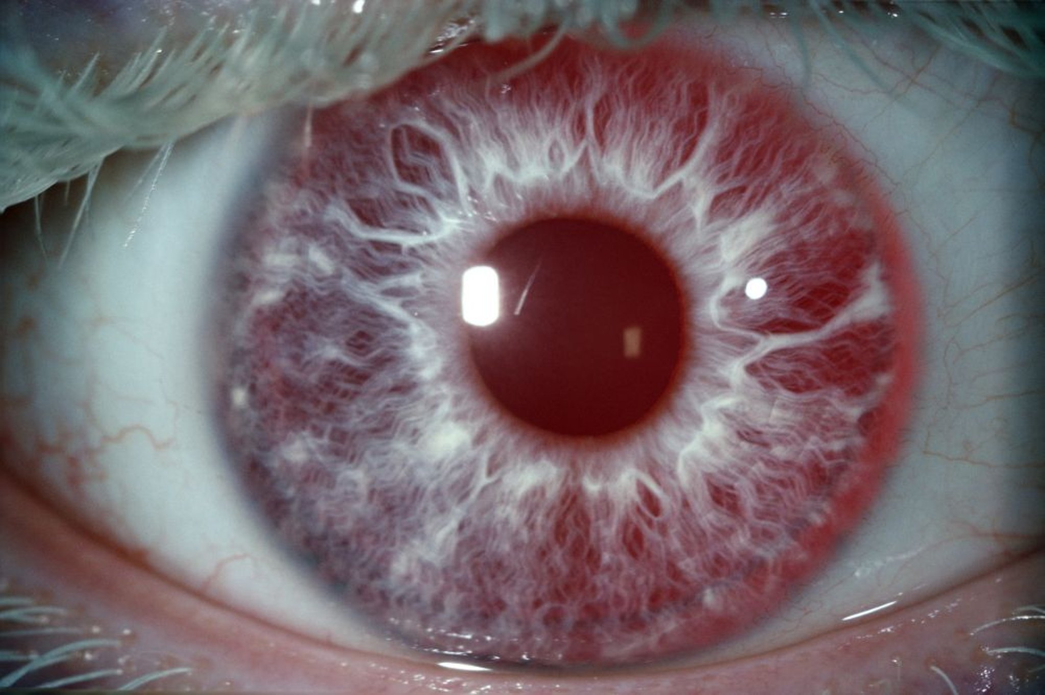 Bệnh bạch tạng (dấu hiệu ở mắt)