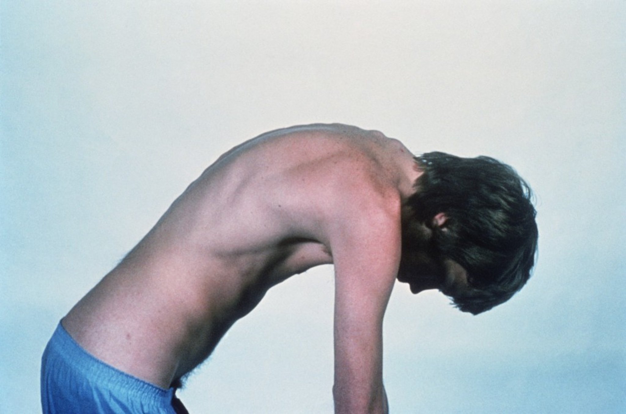 Ankylosing Spondylitis (Severe Kyphosis)