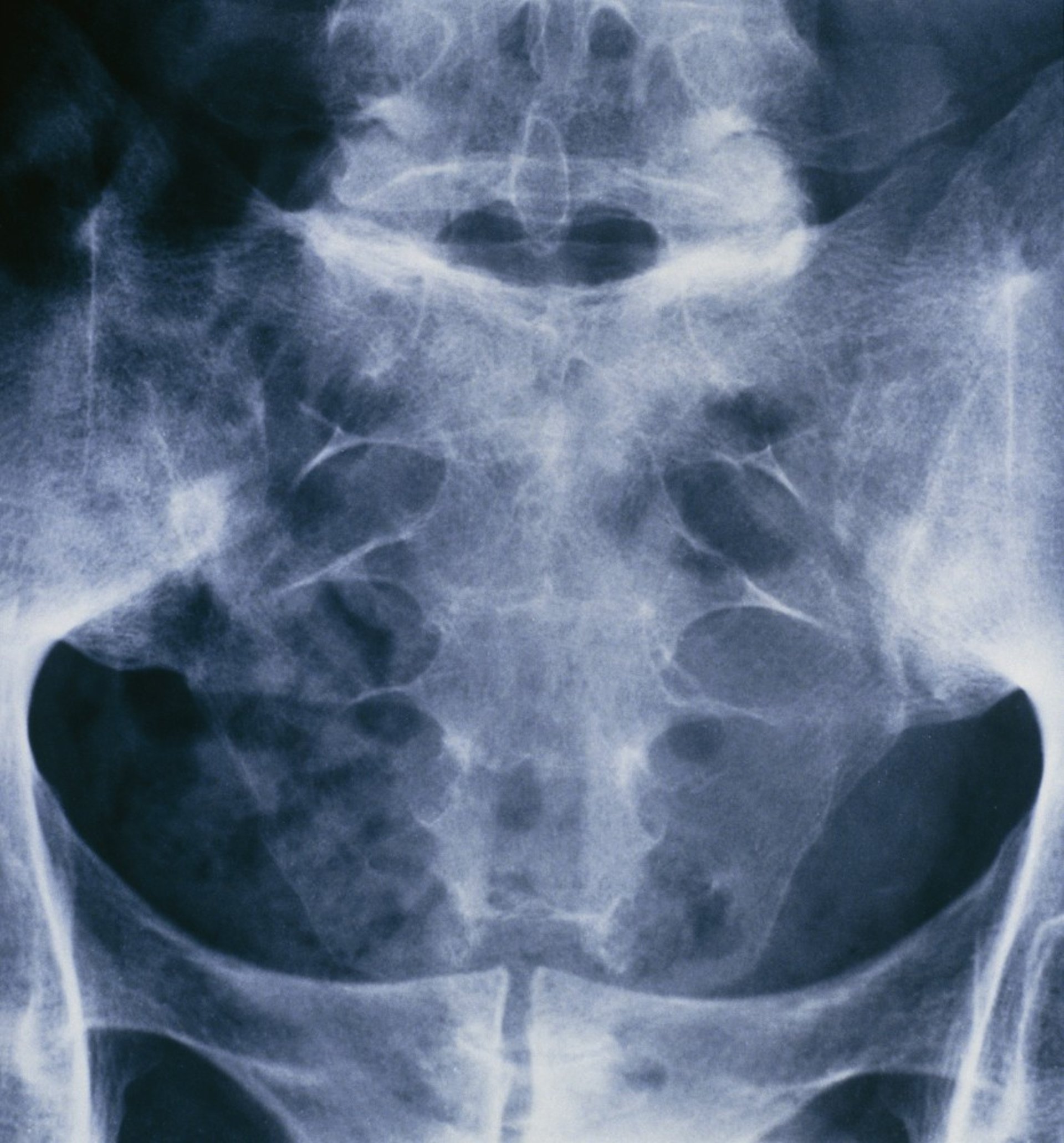 Ankylosing Spondylitis (Sacroiliitis)