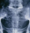 Espondilitis anquilosante (sacroiliitis)