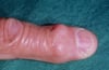 Heberden Nodes (Osteoarthritis)