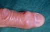 Heberden Nodes (Osteoarthritis)