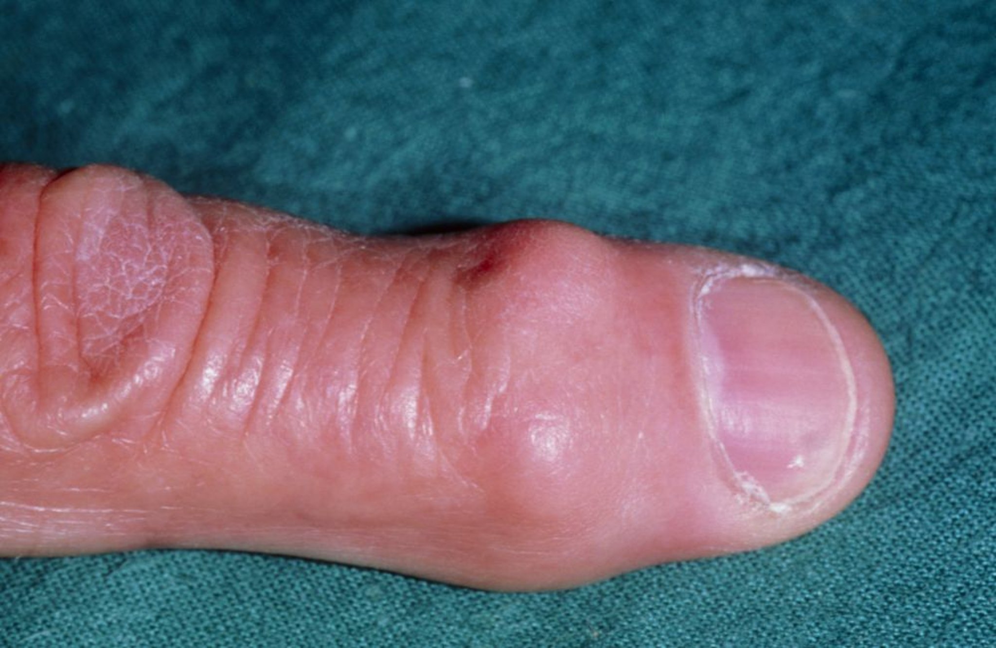 Nốt Heberden Nodes (thoái hóa khớp)