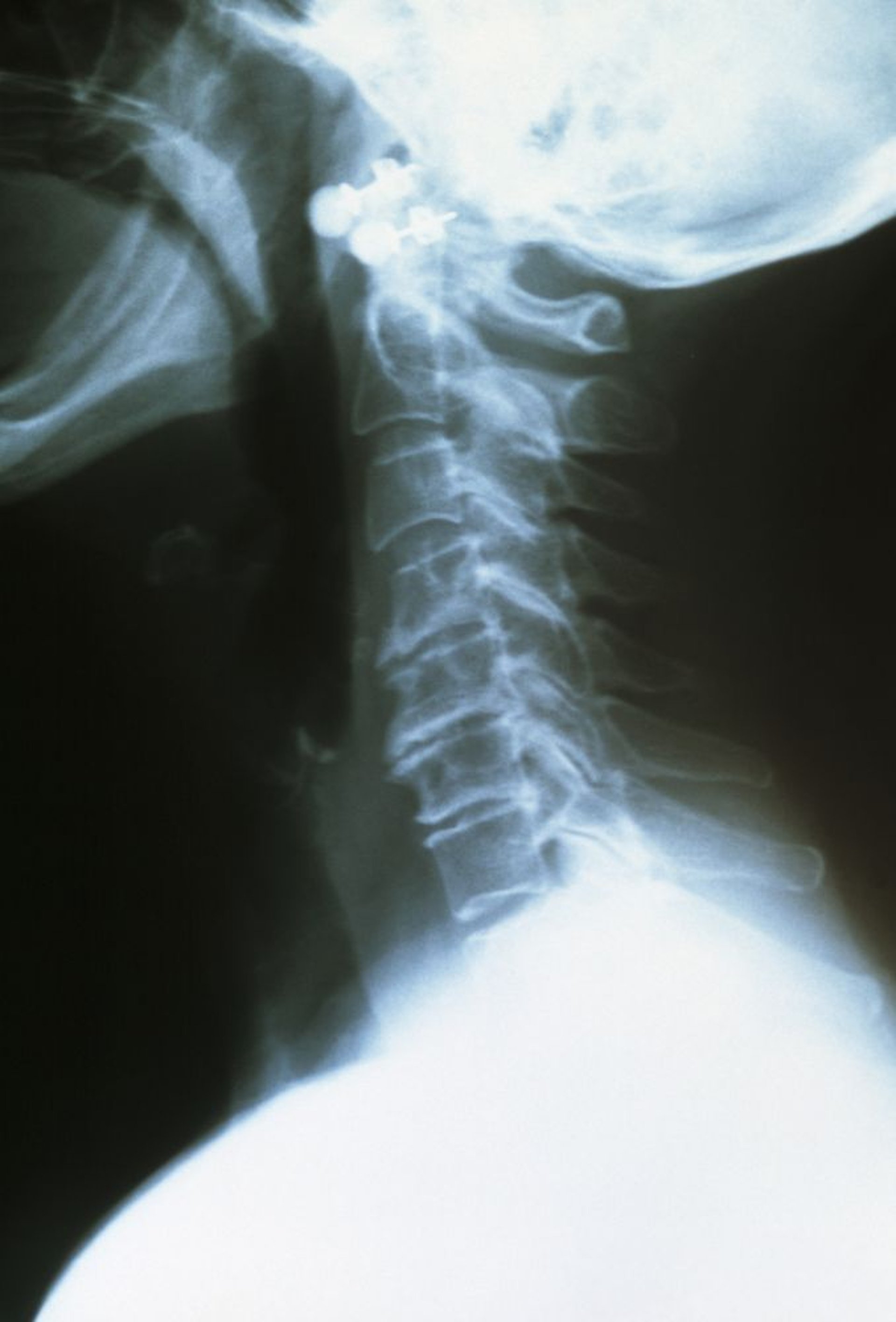 Osteoartrite da coluna cervical