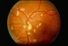 Retinitis (CMV)