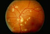 Retinitis (CMV)
