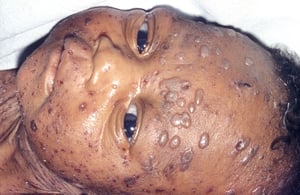 Infección diseminada por el virus herpes simple (HSV) en un recién nacido