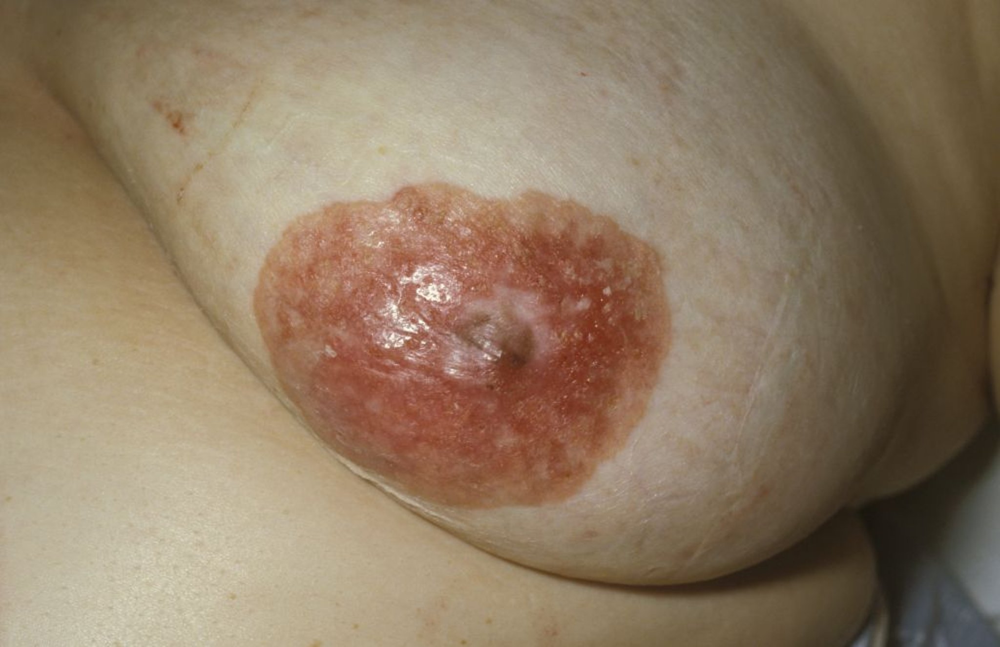 乳头Paget病