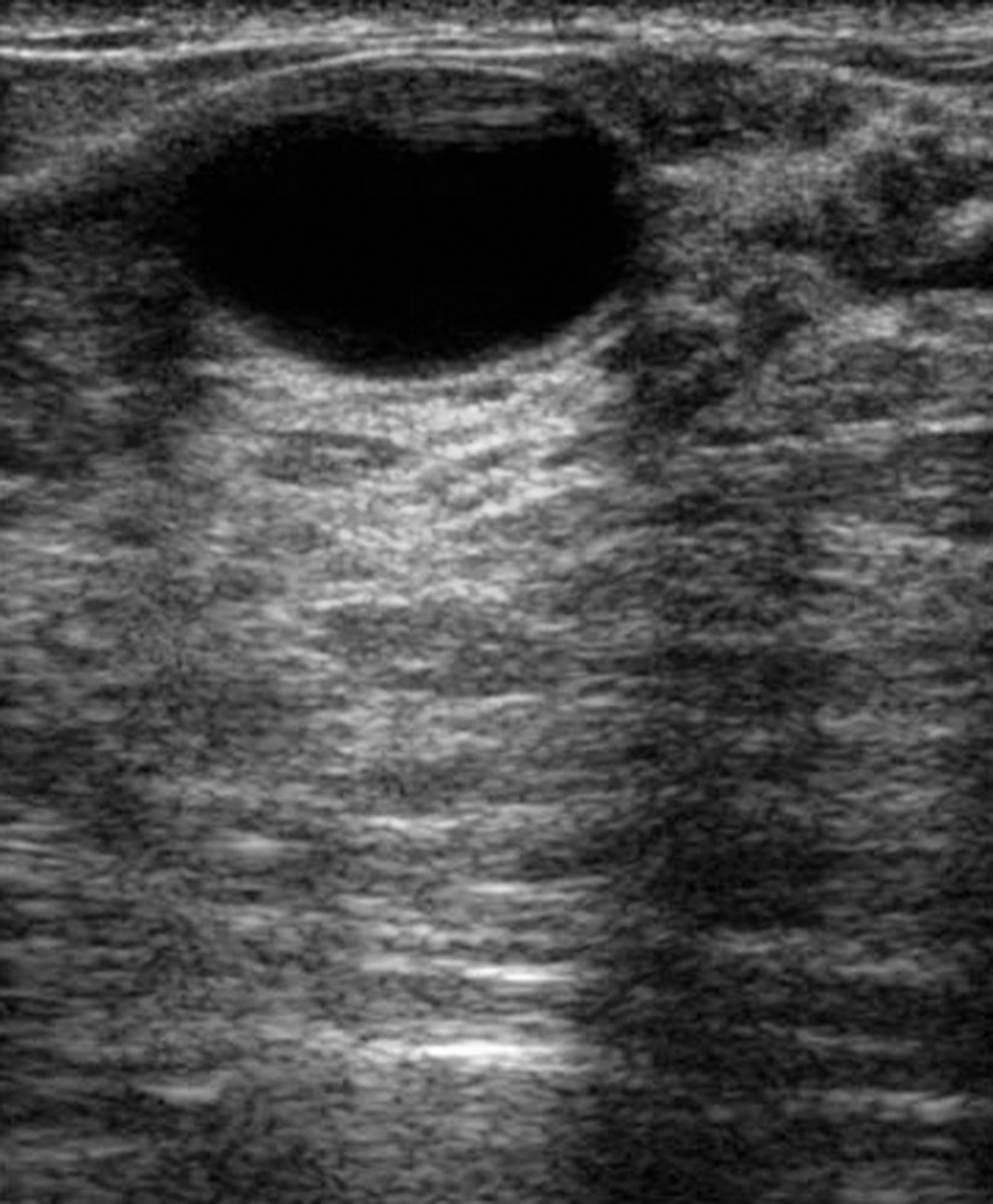 Ultrasound of a Breast Lump (Cyst)