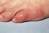 Corn (Little Toe)