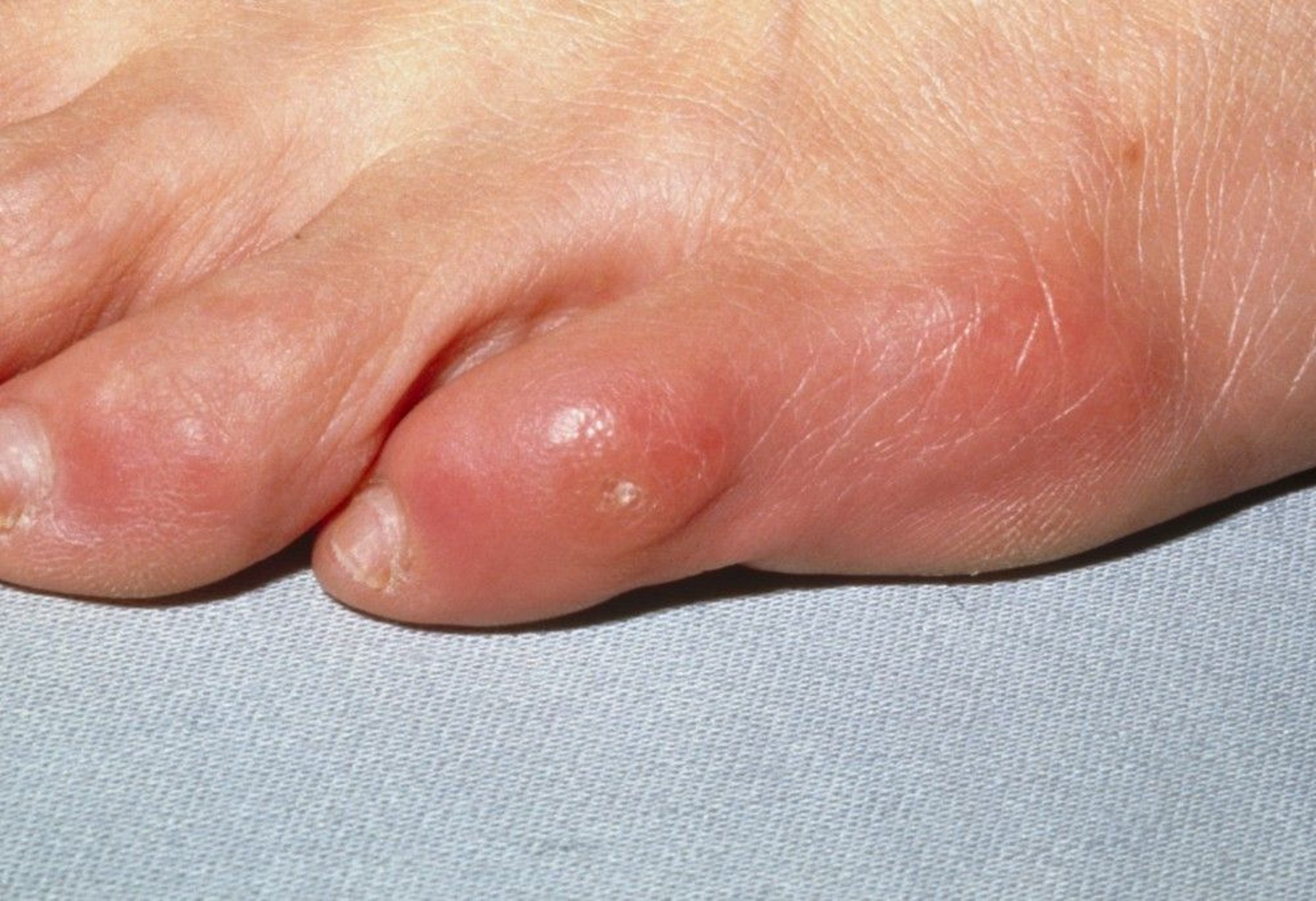 Corn (Little Toe)