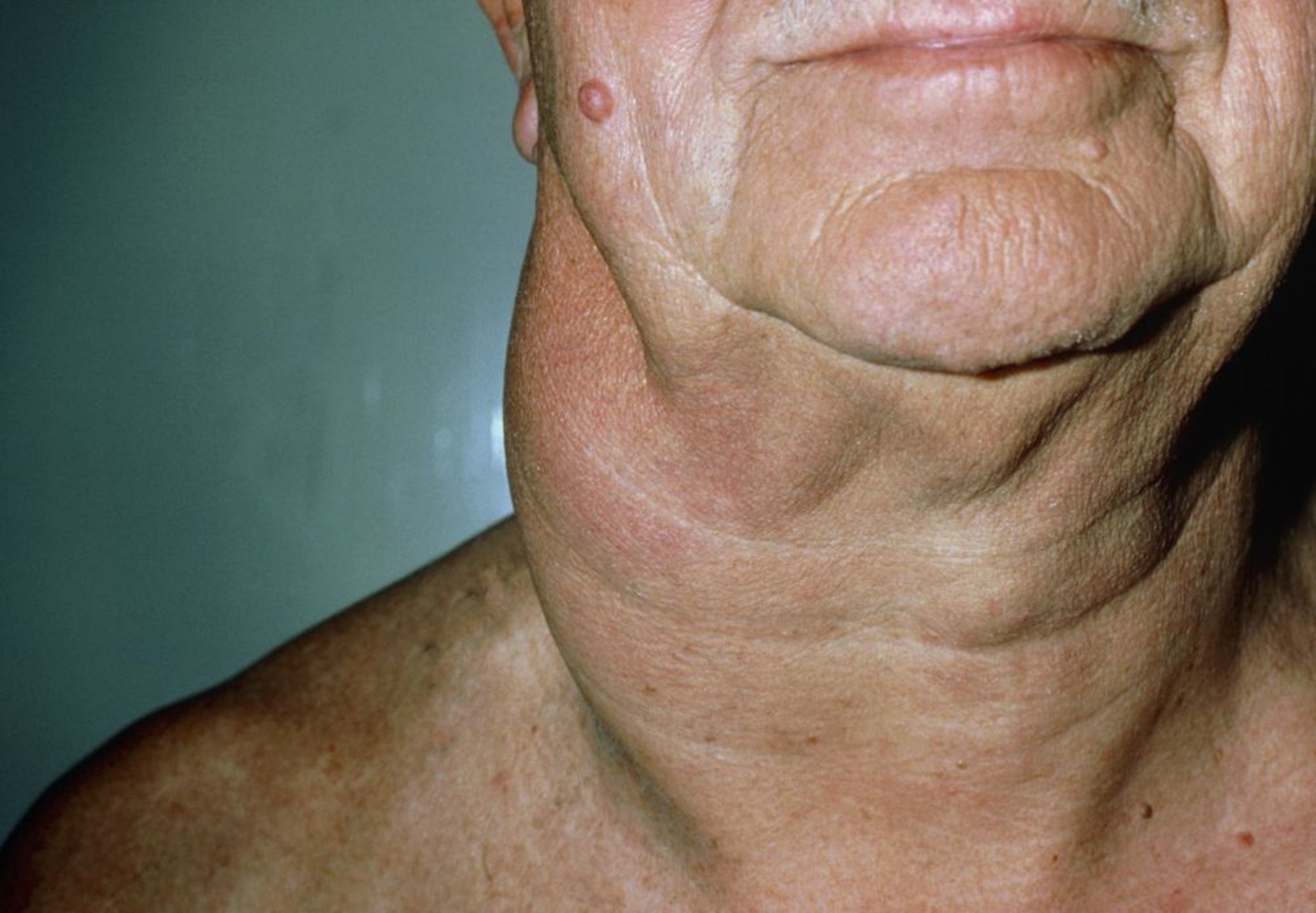 Linfoma não Hodgkin (linfadenopatia cervical)
