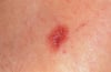 Amelanotic Melanoma