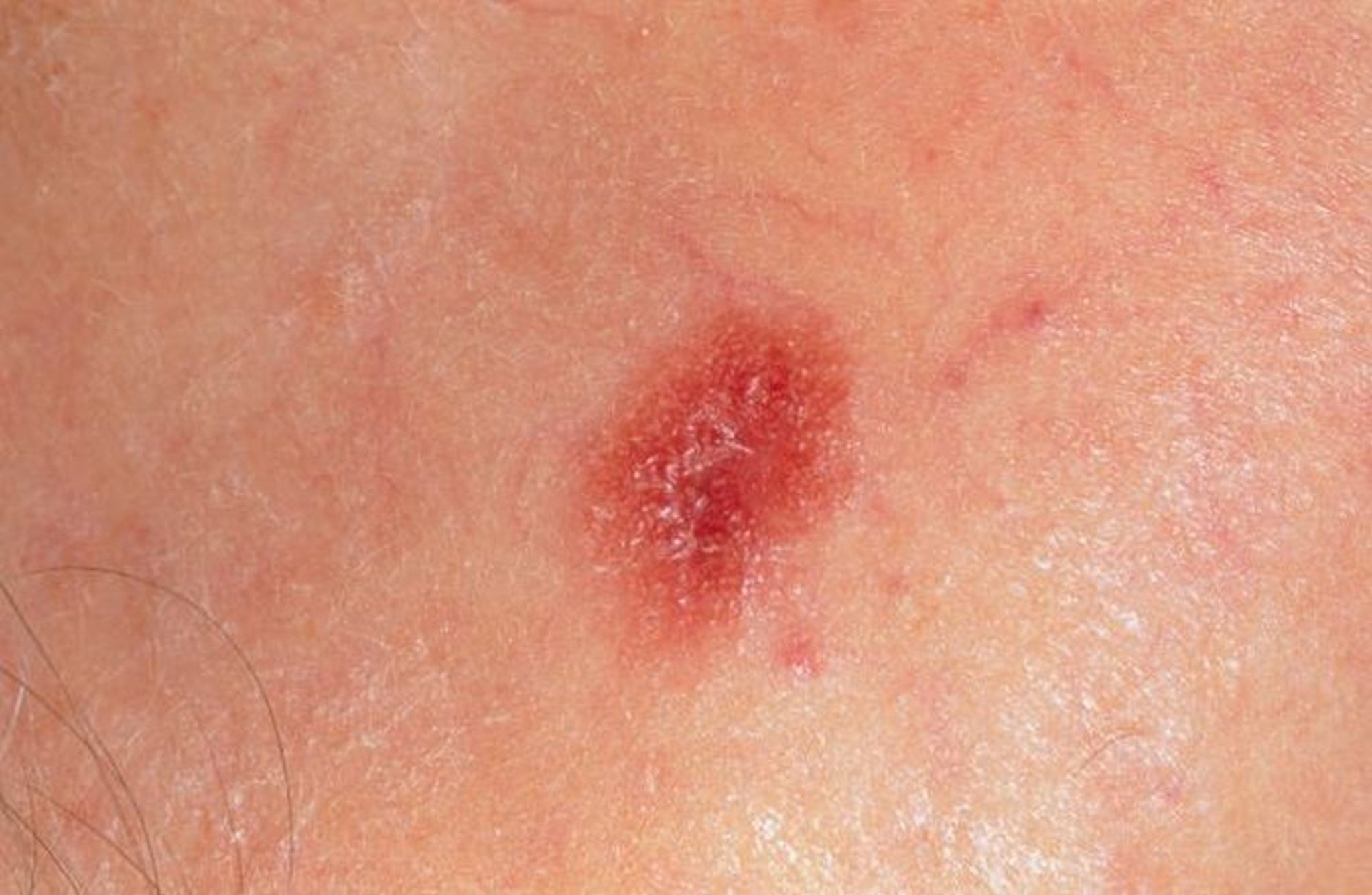 Melanoma amelanótico