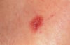 Melanoma amelanotico