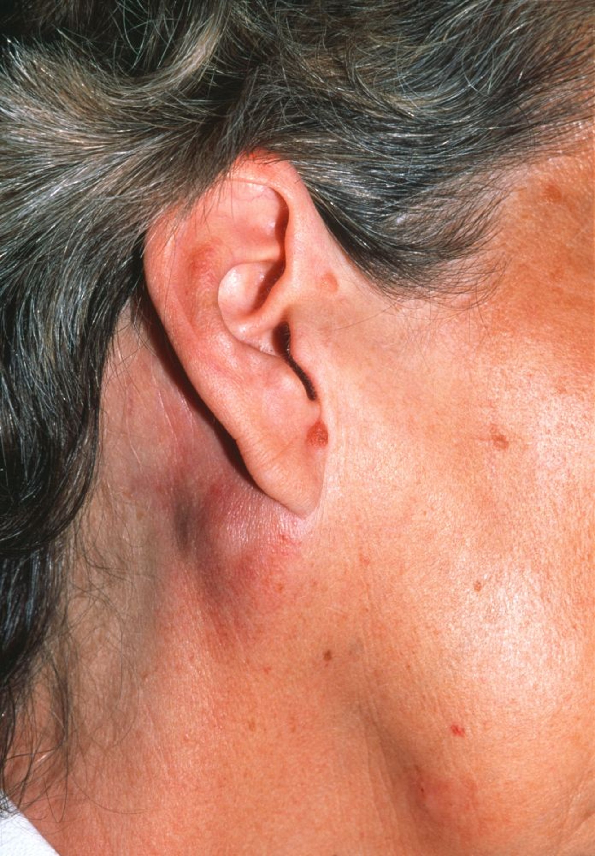 Неходжкинская лимфома (задняя аурикулярная лимфаденопатия)