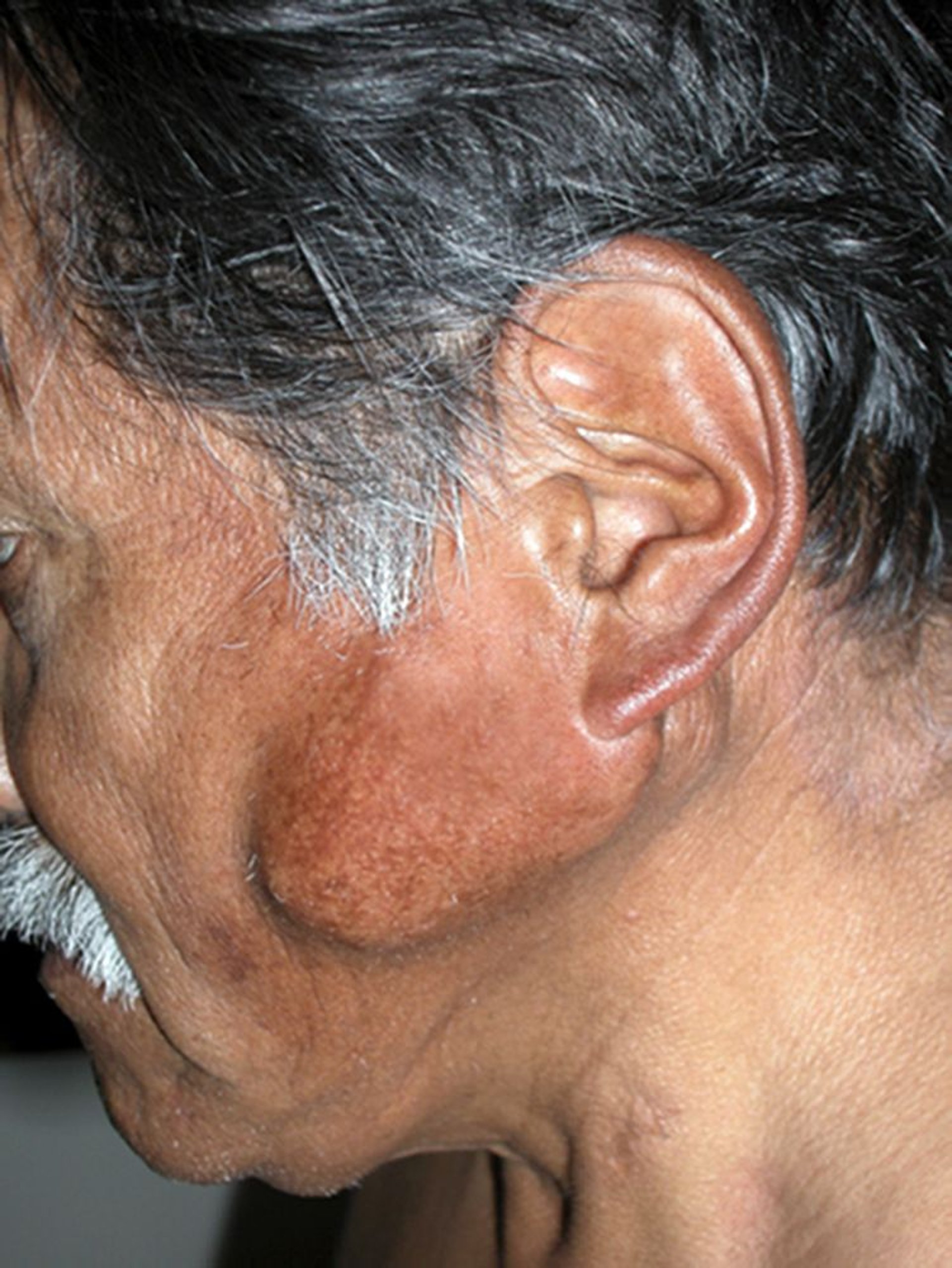 Khối u tuyến nước bọt (bên trái)