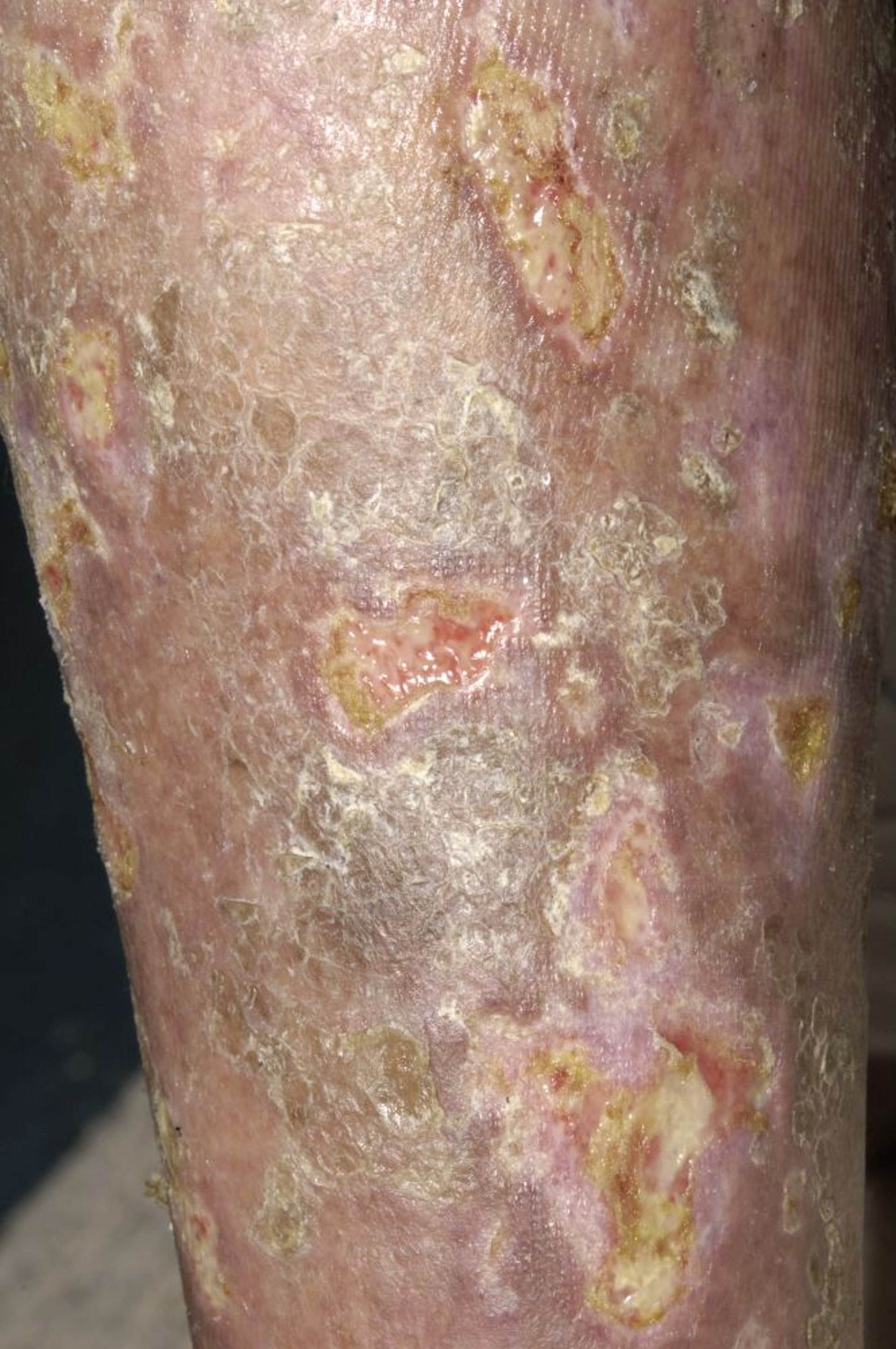 Mycosis fungoides mit Ulzeration