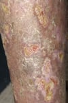 Micosis Fungoide con ulceración
