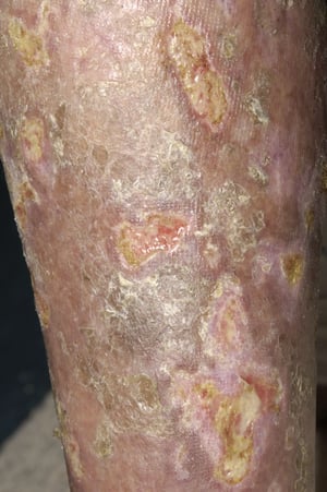 Mycosis fongoïde avec ulcération