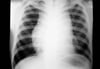 Hodgkin Lymphoma (Mediastinal Lymphadenopathy)