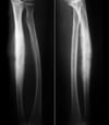 Sarcoma de Ewing del radio
