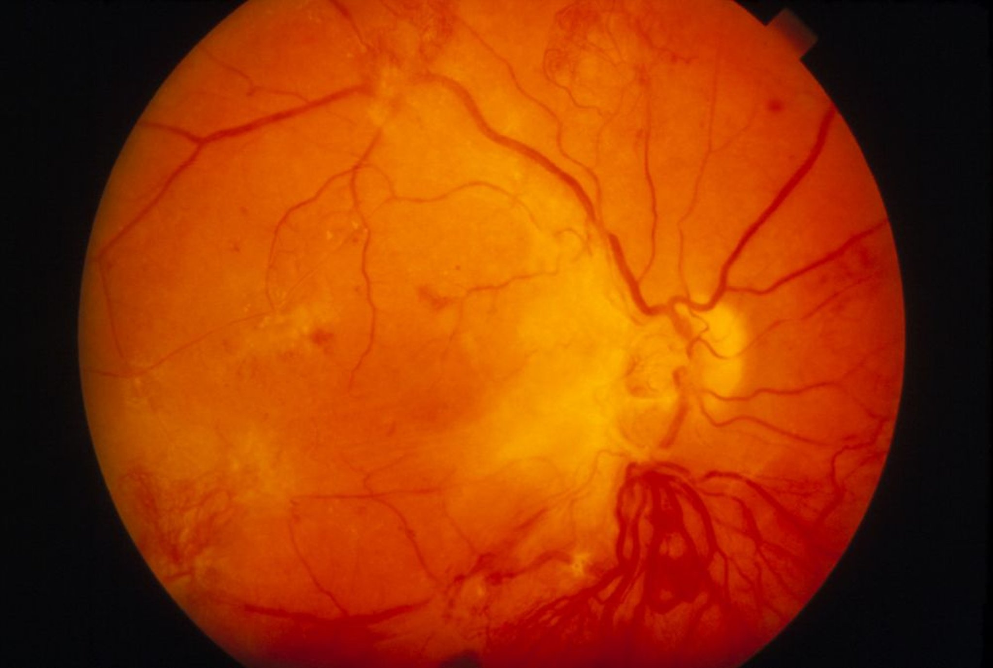 Retinopatia diabetica (proliferante)