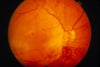 Diabetic Retinopathy (Proliferative)