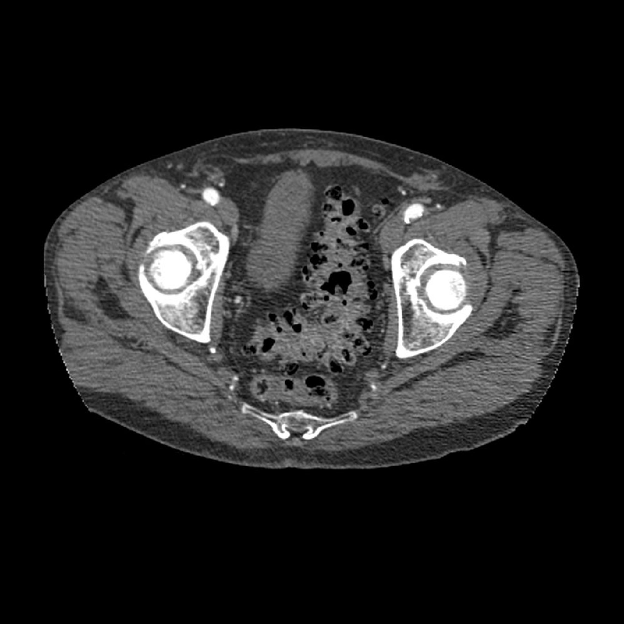 Diverticulose (TDM)