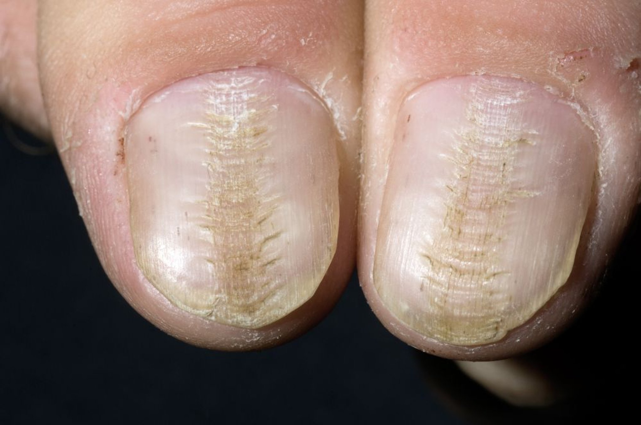 Mediane Nageldystrophie
