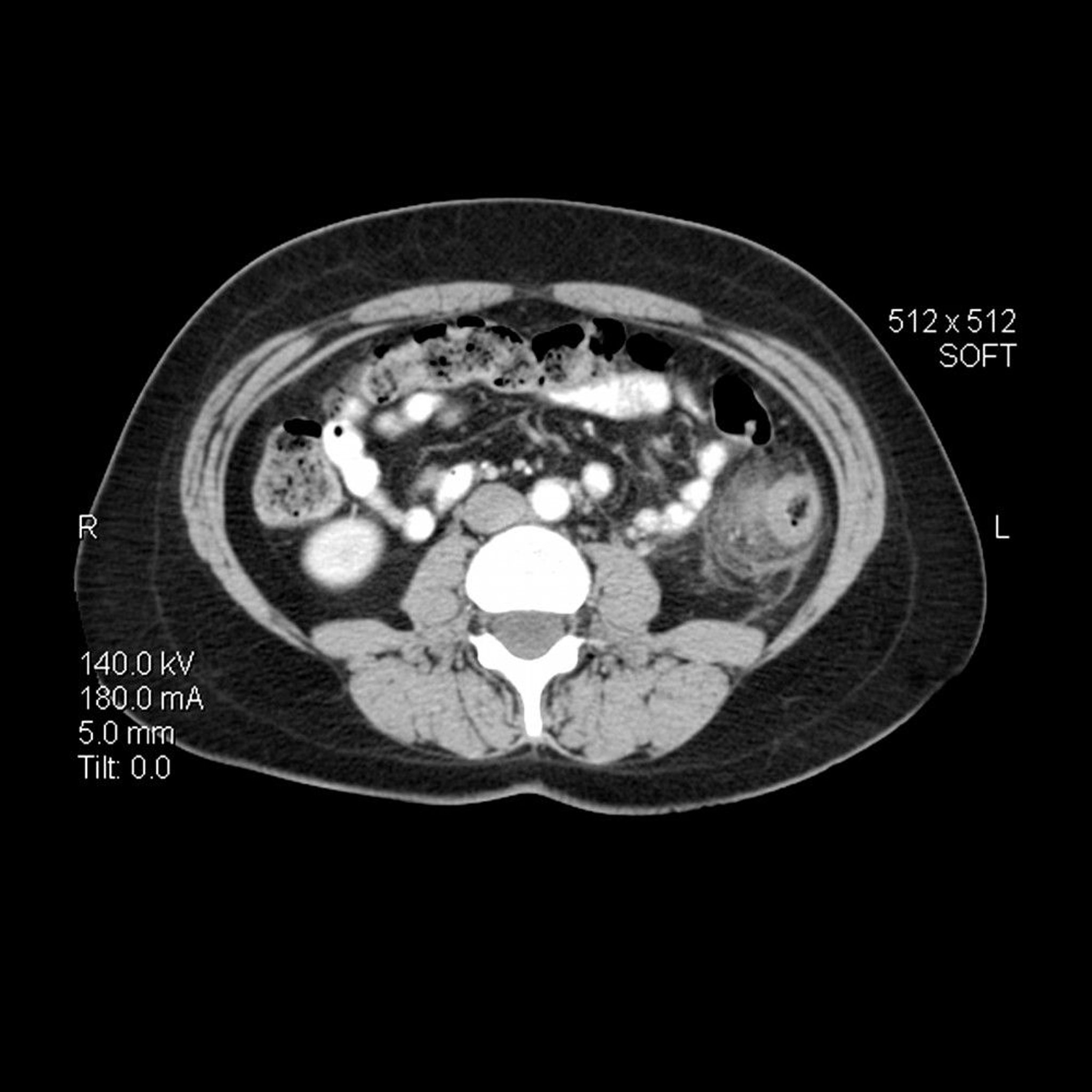 Diverticulitis (CT Scan)