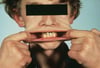 Sindrome di Ehlers-Danlos