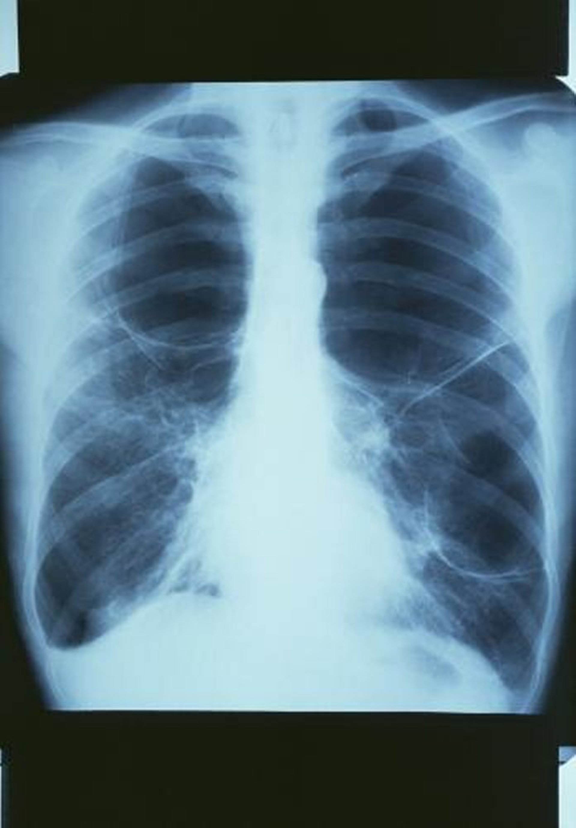 Enfermedad pulmonar obstructiva crónica con bullas