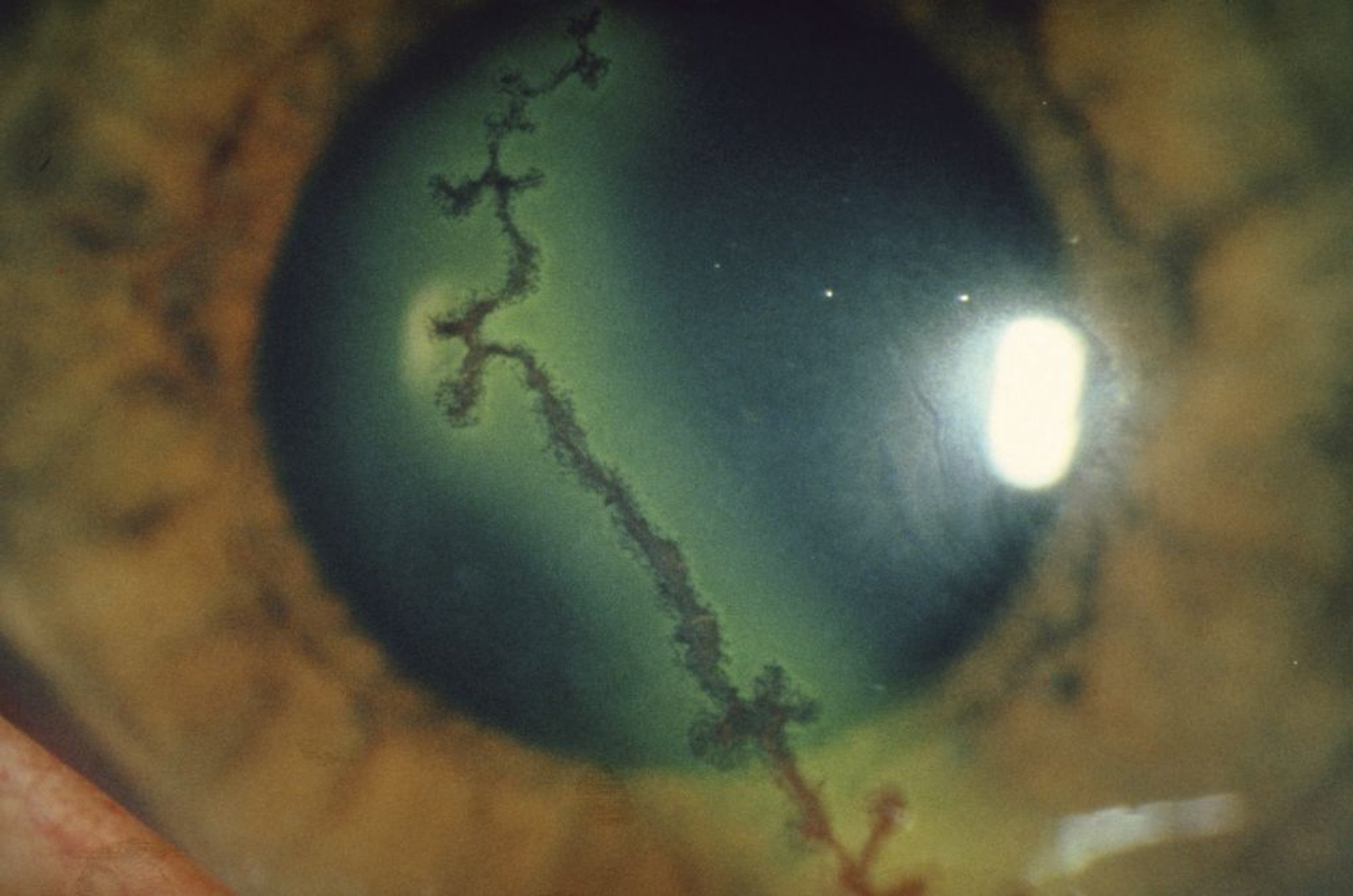 Herpes simplex (dentritische Keratitis)