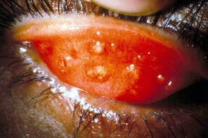 Trachomatous Inflammation–Follicular (TF) and Trachomatous Inflammation–Intense (TI)